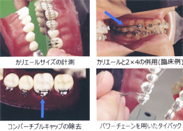 第1巻　アングルⅡ級1類の非抜歯治療法