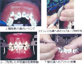 第3巻　アングルⅠ級叢生の抜歯治療法