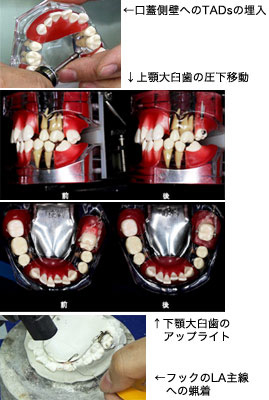 第1巻　大臼歯の圧下移動とアップライト